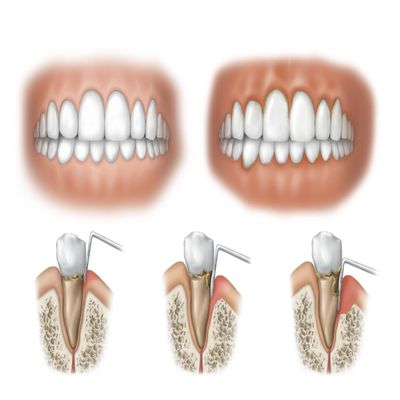 Three stages of periodontal disease Poster Print by TriFocal CommunicationsStocktrek Images (34 x 22)