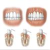 Three stages of periodontal disease Poster Print by TriFocal CommunicationsStocktrek Images (34 x 22) view 1