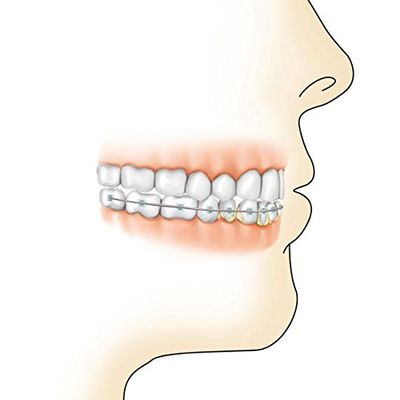 Lower gums with braces and plaque on teeth Poster Print by TriFocal CommunicationsStocktrek Images (24 x 24)