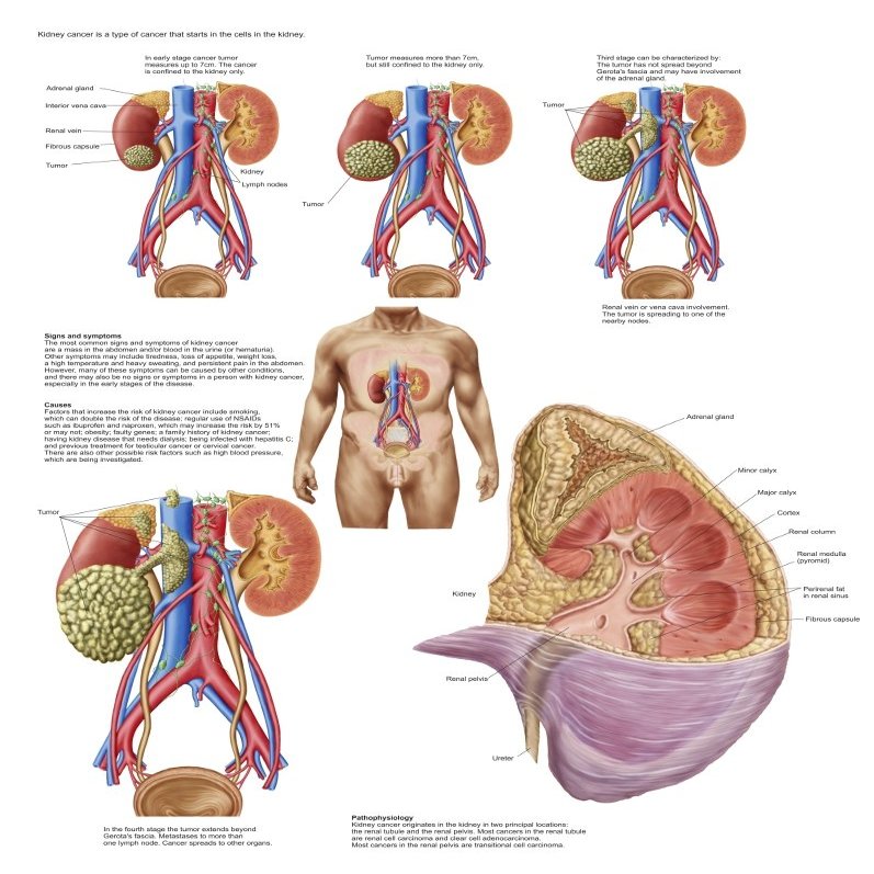 Posterazzi Medical chart showing the signs and symptoms of kidney cancer Poster Print, (25 x 32)