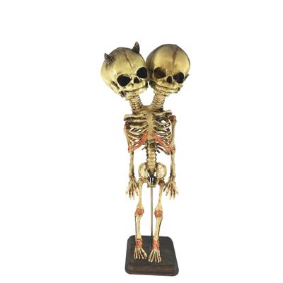 Asylum Zone Evil Twin Siamese Twin Conjoined Demon Devil Fetus Skeleton Oddity